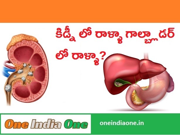 Kidney Stones VS Gallbladder Stones